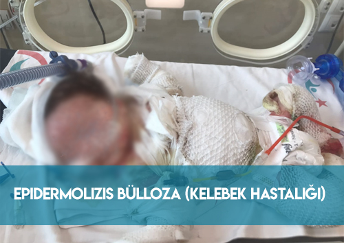 Epidermolizis Bülloza (Kelebek Hastalığı) Nedir?